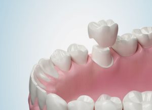 dental crowns types procedure benefits and aftercare