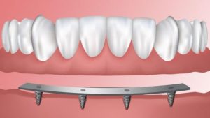 what you need to know about implant supported dentures